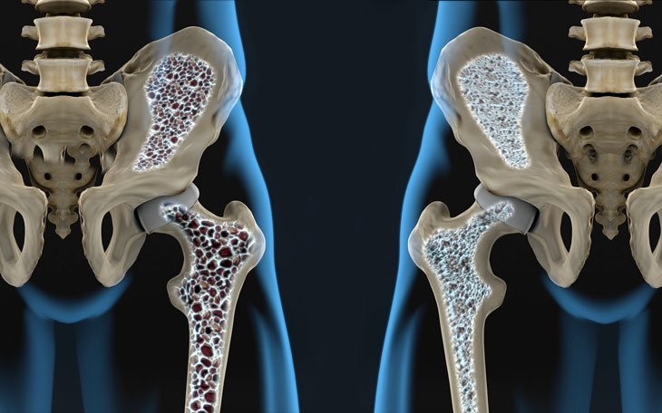 Orientações Fisioterapêuticas para Pacientes com Osteoporose: Um Guia Completo para Qualidade de Vida