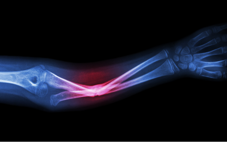 A Importância da Fisioterapia na Recuperação de Fraturas Ósseas